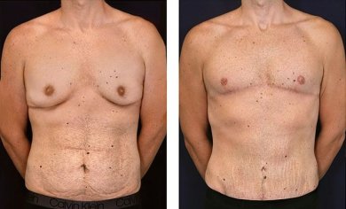 before-after photo gynecomastia-surgery