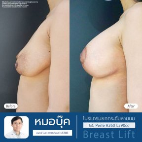Before and after breast lift results at Cosmacare Clinic Center for Aesthetic Medicine and Plastic Surgery
