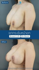 Before and after breast lift results at Cosmacare Clinic Center for Aesthetic Medicine