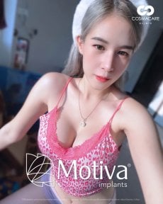 Breast lift with Motiva implants result at Cosmacare Clinic Center for Aesthetic Medicine
