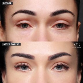 نتائج رفع الحاجب قبل وبعد في VG Plastic Surgery، رفع واضح للحاجب بعد 3 أسابيع