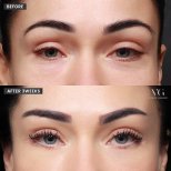 نتائج رفع الحاجب قبل وبعد في VG Plastic Surgery، رفع واضح للحاجب بعد 3 أسابيع