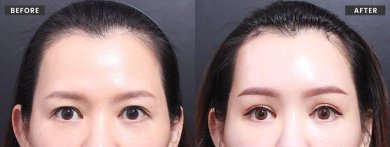 نتائج شد الحاجب قبل وبعد في VG Plastic Surgery – رفع الحواجب ومظهر متجدد