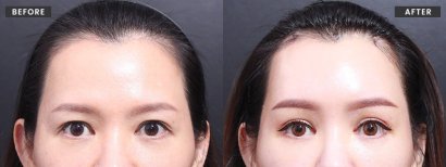 نتائج شد الحاجب قبل وبعد في VG Plastic Surgery – رفع الحواجب ومظهر متجدد