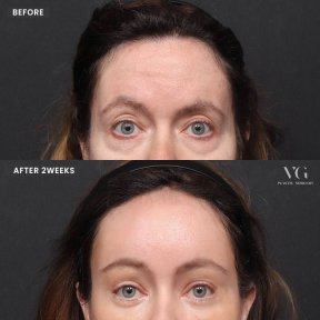 نتائج شد الحاجب قبل وبعد في VG Plastic Surgery – جبين مرفوع ومظهر أكثر شبابًا