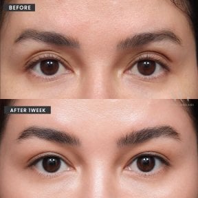 نتائج شد الوجه قبل وبعد في VG Plastic Surgery – تجديد منطقة حول العينين