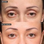 نتائج جراحة الجفن في VG Plastic Surgery مع تجديد واضح لمنطقة العين