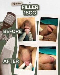 До и после увеличения пениса филлером 18cc в Menness Wellness Clinic, видимый результат