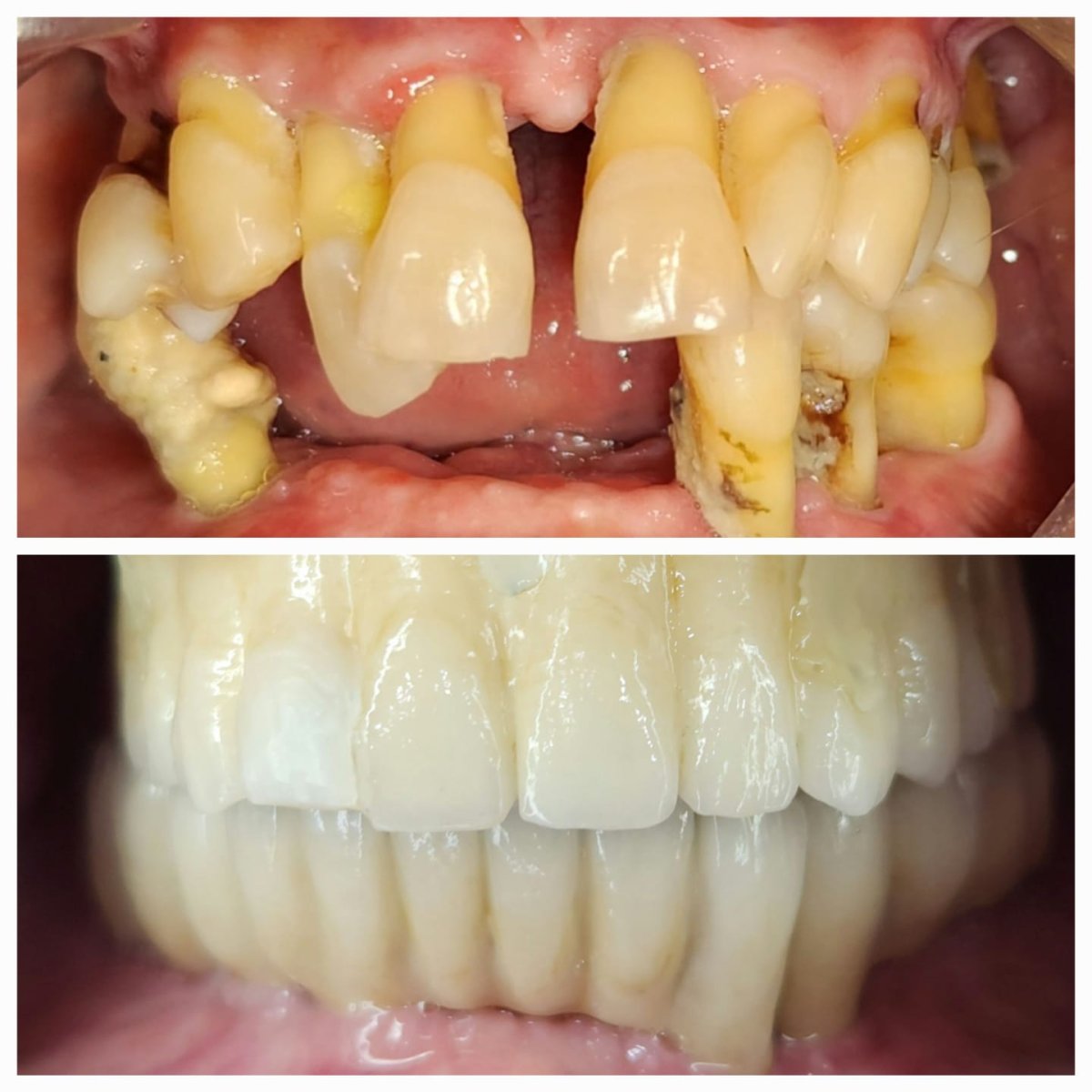 Resultados antes y después de implantes dentales All-on-6: restauración total de la sonrisa