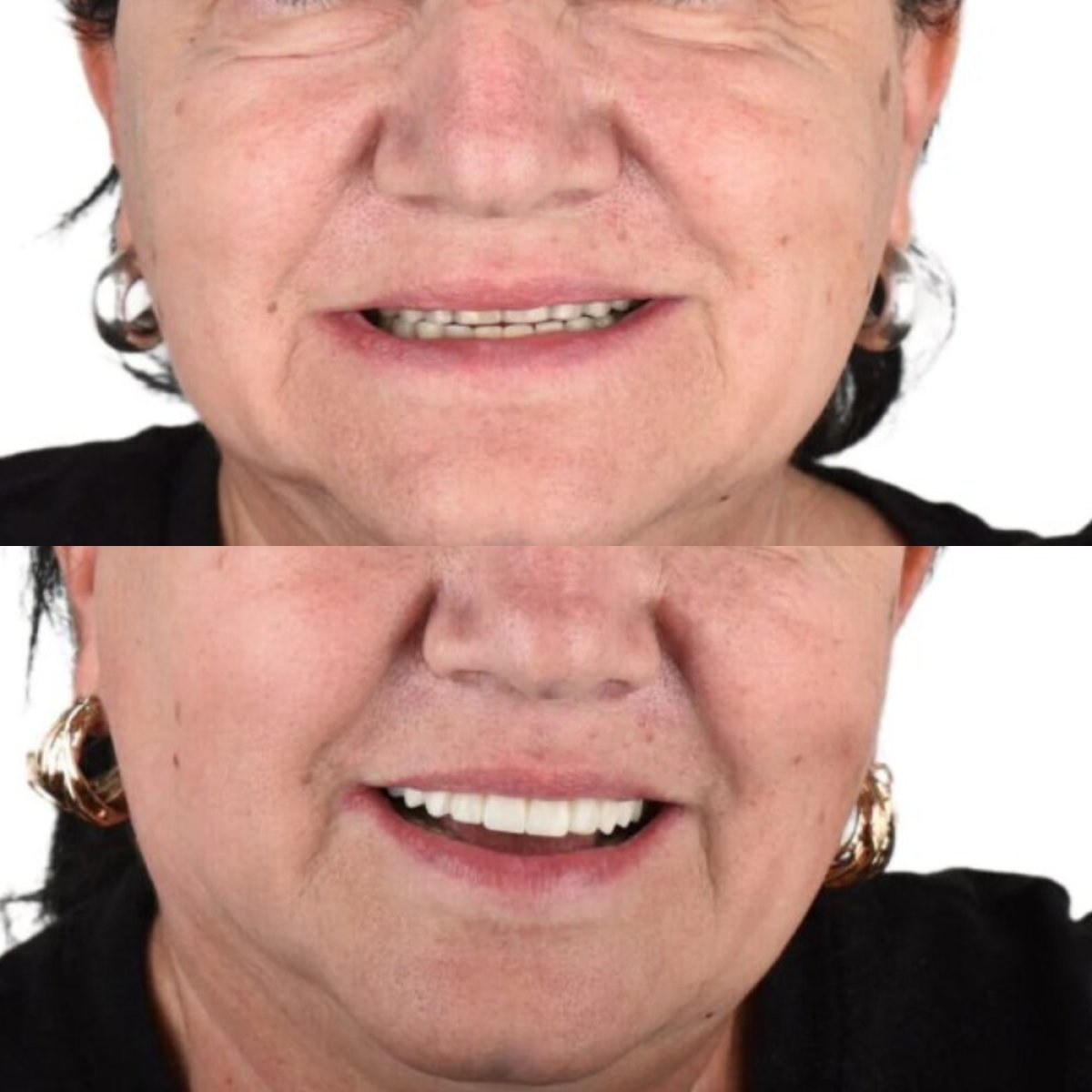 نتائج تبييض الأسنان قبل وبعد في Astra Dental Clinic – ابتسامة أكثر بياضًا بوضوح