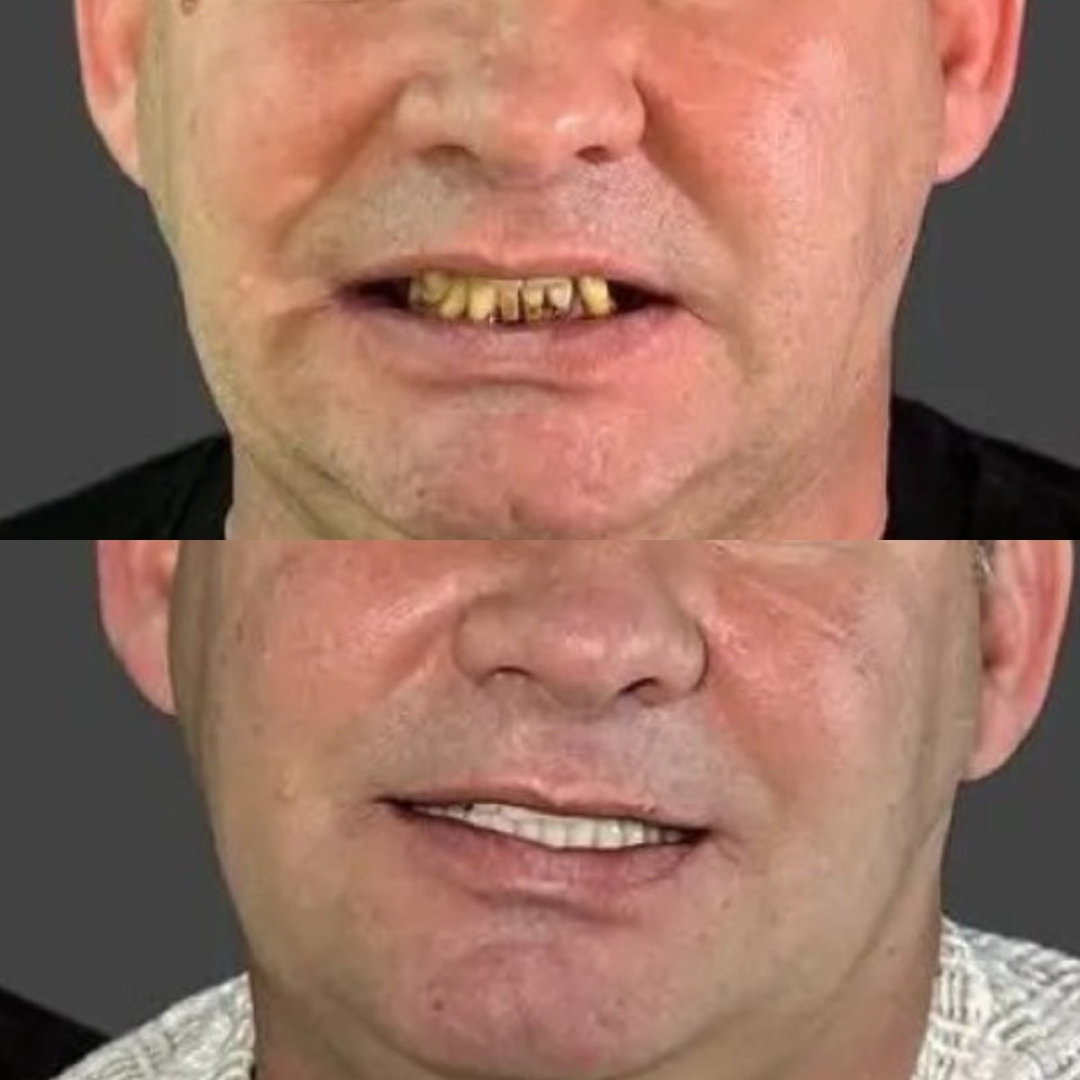 Resultados de blanqueamiento dental antes y después en Astra Dental Clinic, sonrisa mejorada
