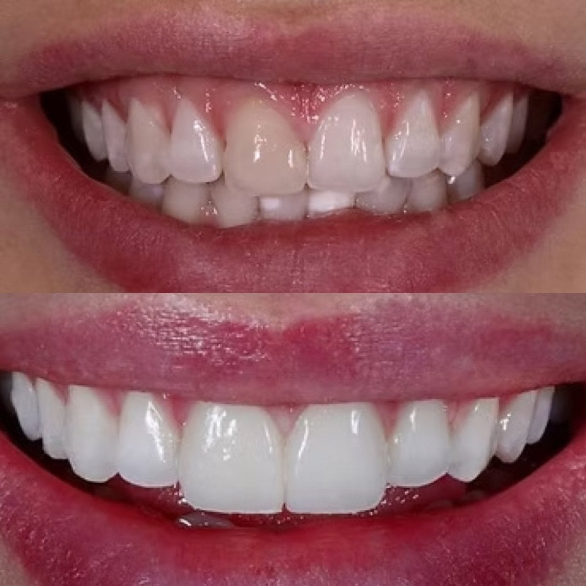Resultado antes y después de carillas en Funda Sarıkaya Diş Polikliniği - Dental Clinic, sonrisa renovada