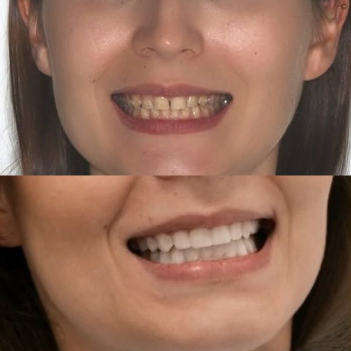 نتائج قبل وبعد تجميل الأسنان بالترابط في Corten Dental Elite، تحسين جمالية الابتسامة