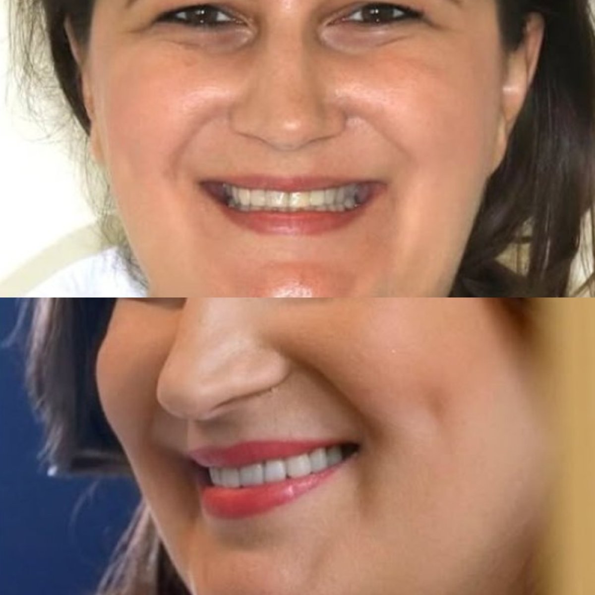 نتائج قبل وبعد ابتسامة هوليود في Corten Dental Elite، تحول ملحوظ في الابتسامة