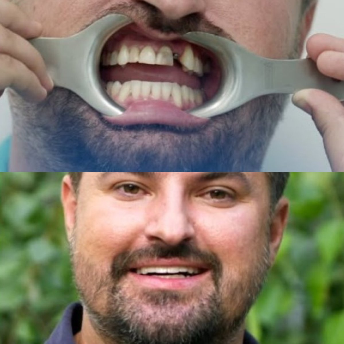نتائج قبل وبعد تجميل الابتسامة في Corten Dental Elite، تحسين انتظام الأسنان