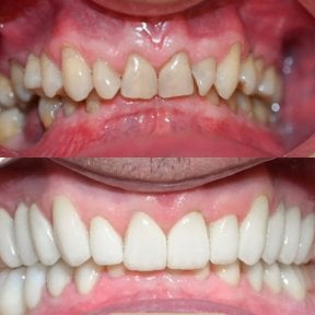 before-after photo smile-makeover