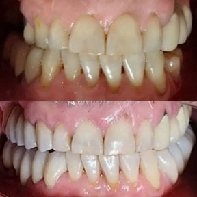 before-after photo smile-makeover