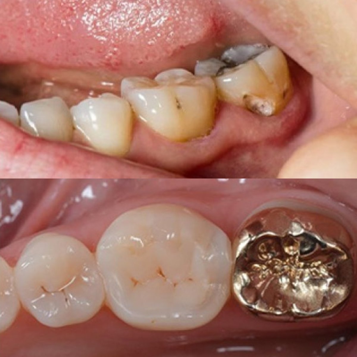 نتيجة قبل وبعد تركيب تاج ذهبي في SAIGON CENTER DENTAL CLINIC، ترميم الضرس