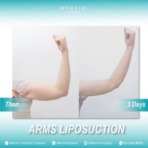before-after photo mastopexy-breast-lift-contour-plastics