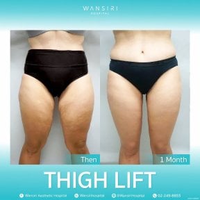 before-after photo mastopexy-breast-lift-contour-plastics