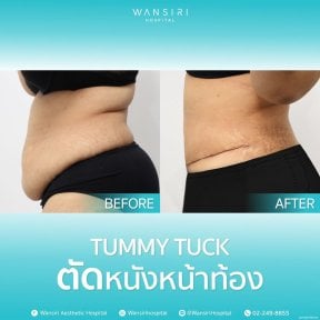 before-after photo mastopexy-breast-lift-contour-plastics