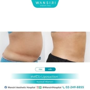 before-after photo mastopexy-breast-lift-contour-plastics