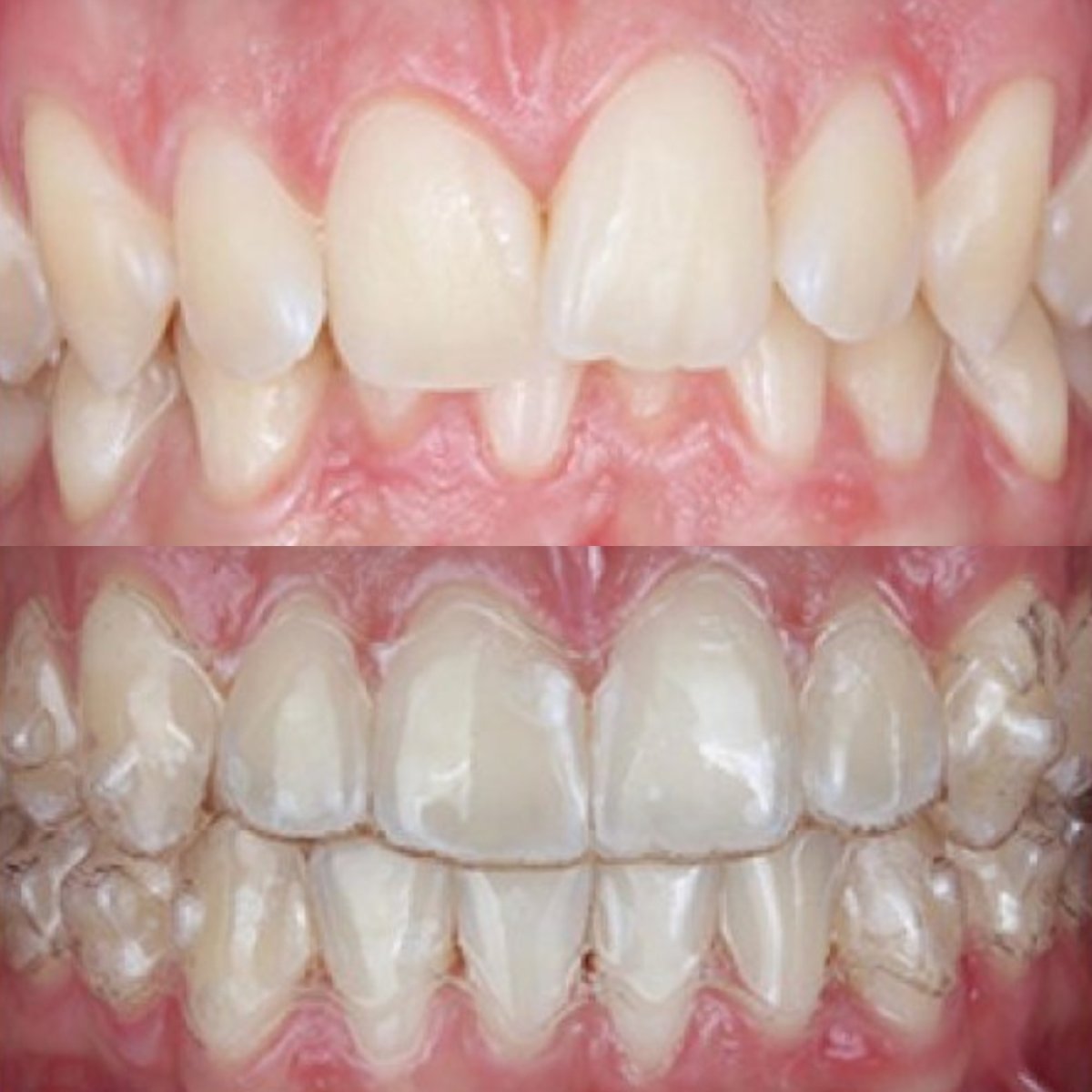 نتيجة قبل وبعد علاج التقويم الشفاف في SAIGON CENTER DENTAL CLINIC، تقويم الأسنان