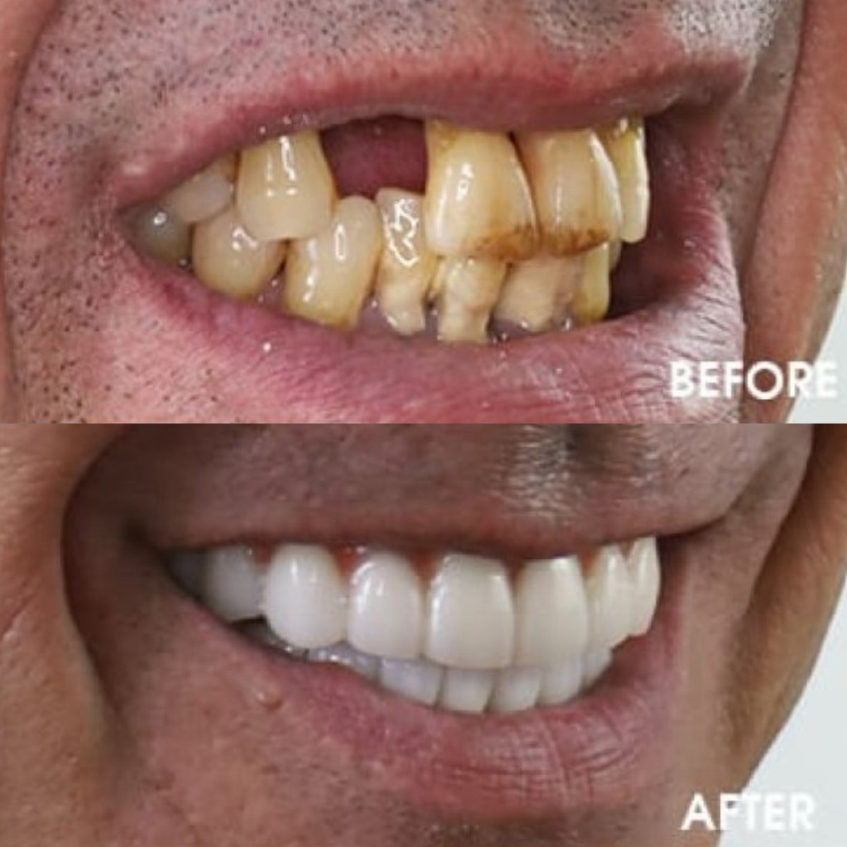 نتائج قبل وبعد تركيب طقم الأسنان في SAIGON CENTER DENTAL CLINIC – ابتسامة مستعادة