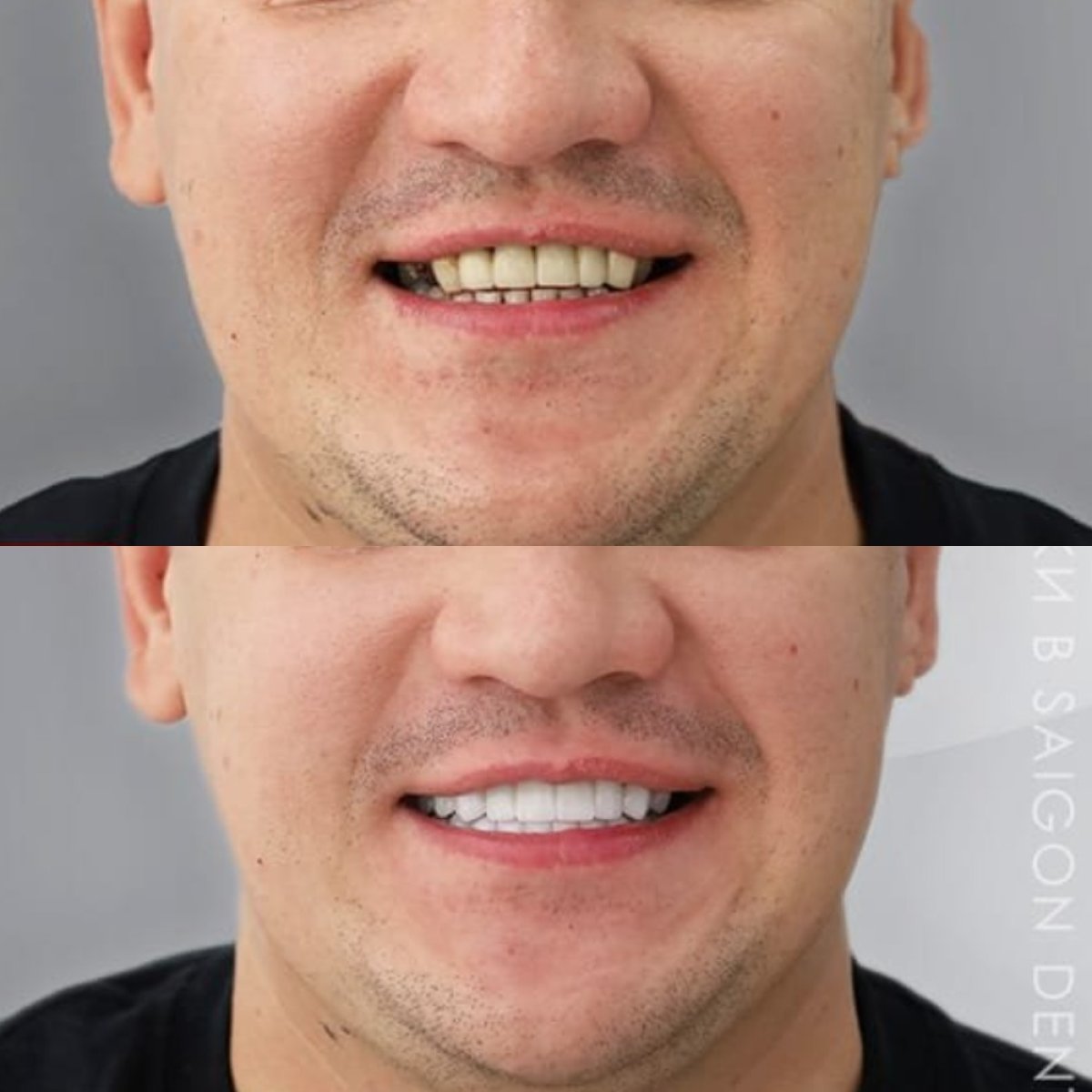 Resultados antes y después de coronas de porcelana en SAIGON CENTER DENTAL CLINIC, sonrisa