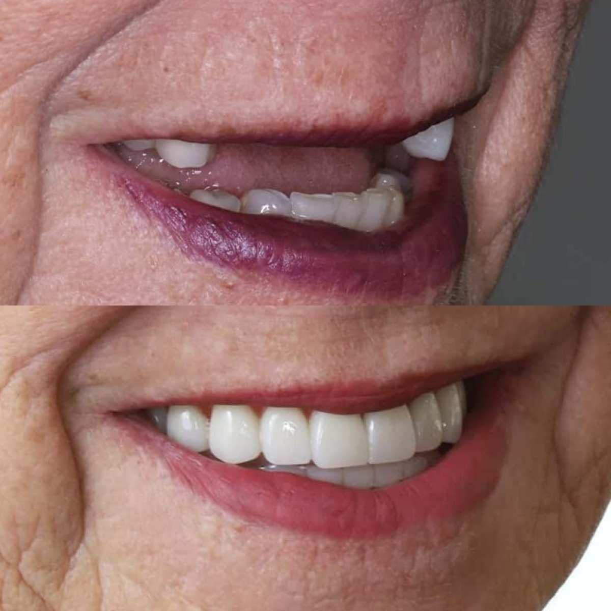 Resultados antes y después de implantes dentales en SAIGON CENTER DENTAL CLINIC, sonrisa restaurada