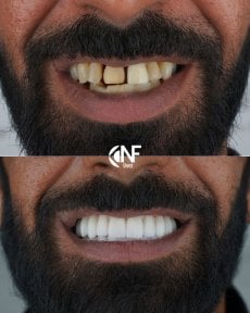 before-after photo all-on-4-dental-implants