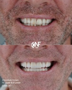 before-after photo protezirovanie-molyarov