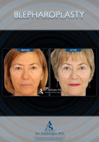 before-after photo upper-and-lower-eyelid-surgery