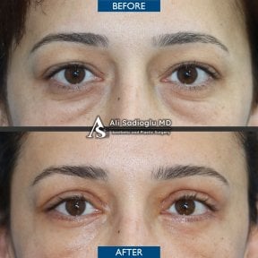 before-after photo upper-and-lower-eyelid-surgery
