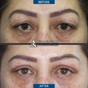 before-after photo upper-and-lower-eyelid-surgery