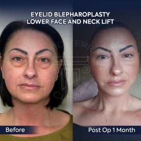 before-after photo upper-and-lower-eyelid-surgery