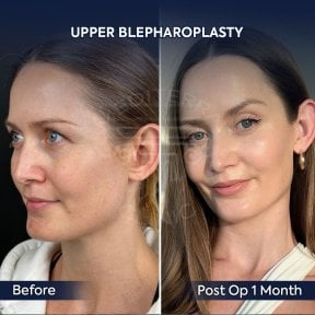 before-after photo upper-and-lower-eyelid-surgery