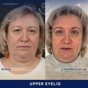 before-after photo upper-and-lower-eyelid-surgery