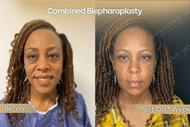 before-after photo upper-and-lower-eyelid-surgery