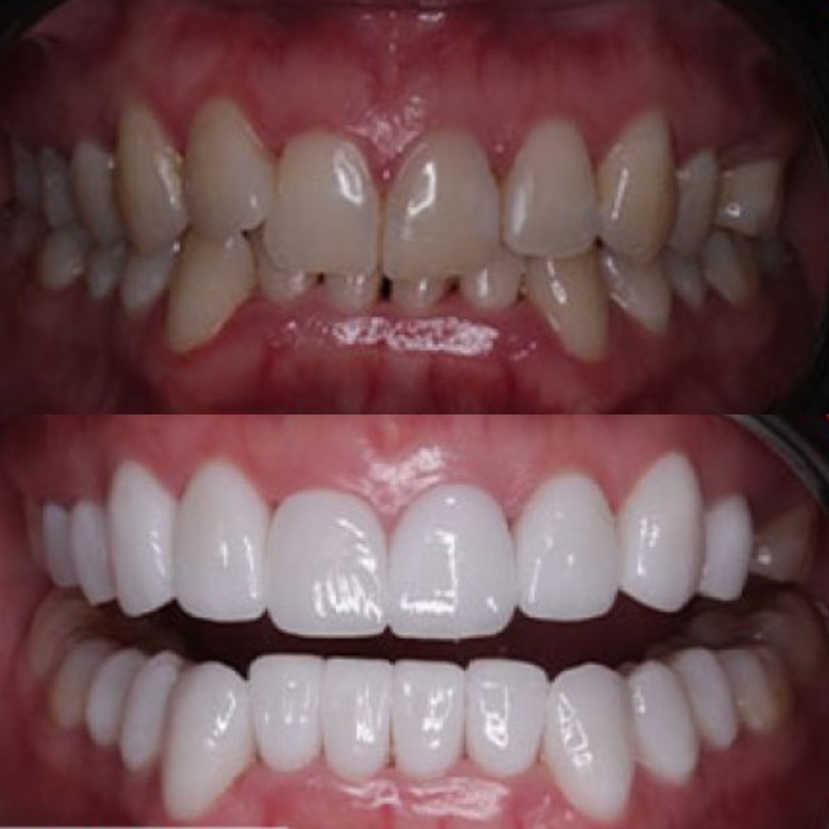قبل وبعد الفينير في SAIGON CENTER DENTAL CLINIC، نتائج تجميل الابتسامة