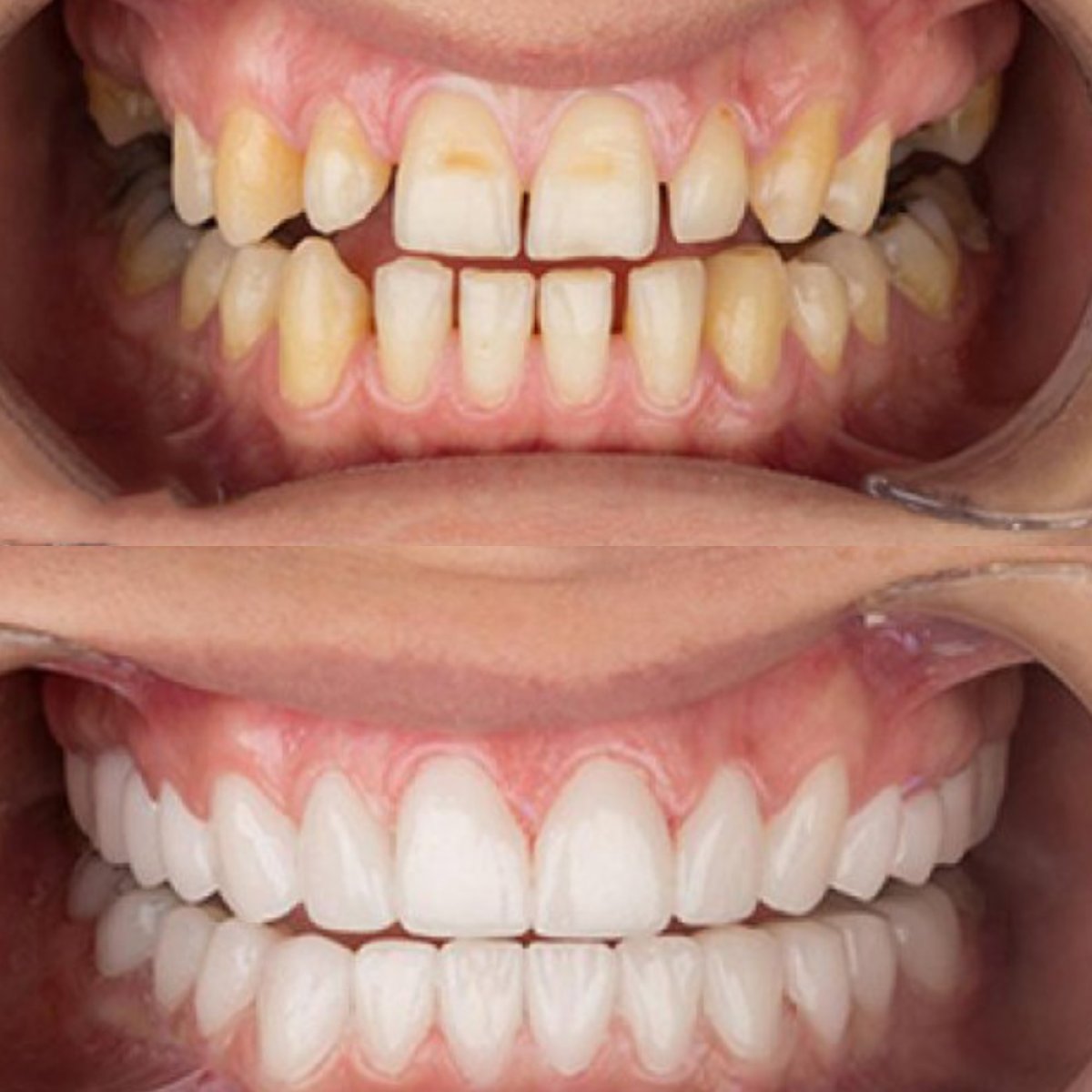 Antes y después de carillas dentales en SAIGON CENTER DENTAL CLINIC, resultado de sonrisa