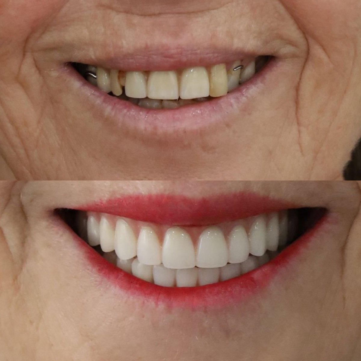 Resultado antes y después de implantes All-on-2 en SAIGON CENTER DENTAL CLINIC, sonrisa mejorada