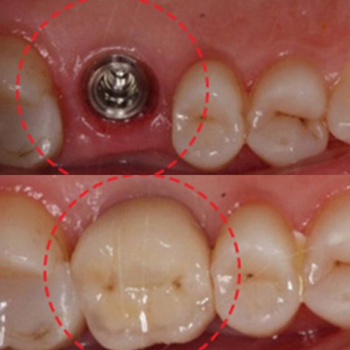 نتائج قبل وبعد زراعة الأسنان مع التاج في SAIGON CENTER DENTAL CLINIC، ترميم واضح للسن