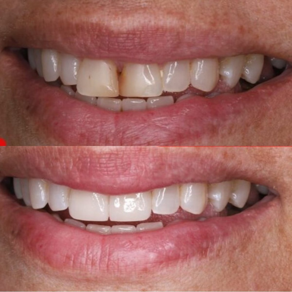 نتائج قبل وبعد ابتسامة هوليود في SAIGON CENTER DENTAL CLINIC، أسنان بيضاء ومتناسقة