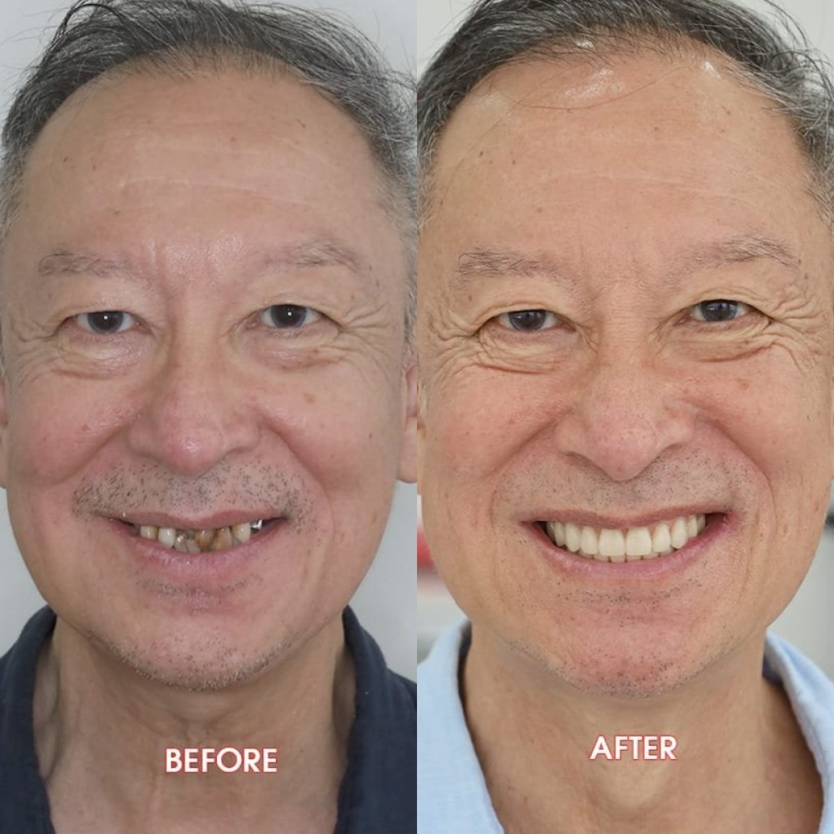 Resultados antes y después de implantes dentales en SAIGON CENTER DENTAL CLINIC, sonrisa restaurada
