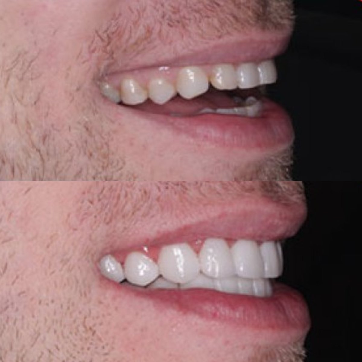 نتيجة قبل وبعد الفينير في SAIGON CENTER DENTAL CLINIC، تحسين جمالية الابتسامة
