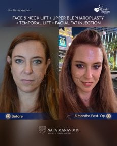 Before and after facial fat transfer result at Dr. Safa Manav Clinic, visible rejuvenation