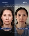 Before and after facial fat transfer results at Dr. Safa Manav Clinic, improved facial volume