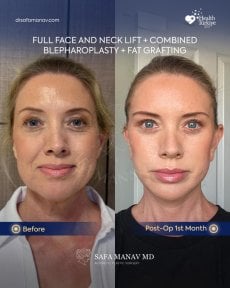 Before and after full face and neck lift with fat transfer at Dr. Safa Manav Clinic results
