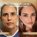 Before and after facial fat transfer, face and neck lift at Dr. Safa Manav Clinic results